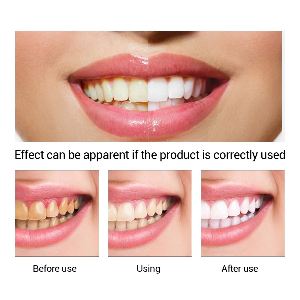 FTEENPLY Sbiancamento Dei Dent - Teeth Whitening Zimba recensione e prezzo